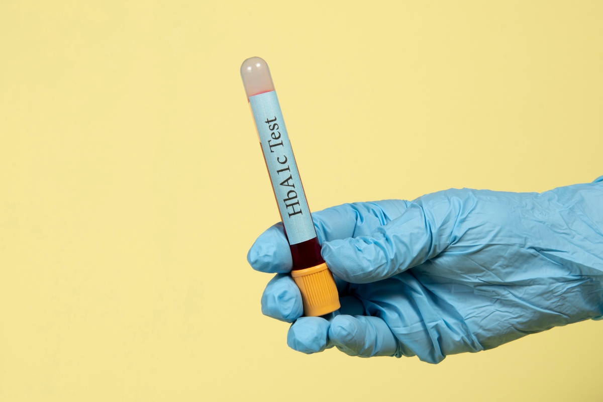 Blood sample in a vacuum tube for hemoglobin A1c test